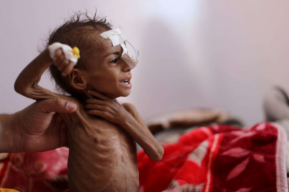 Un'infermiera assiste un bambino malnutrito all'ospedale al-Sabeen a Sanaa, Yemen (ottobre 2020) - REUTERS/Khaled Abdullah/File Photo