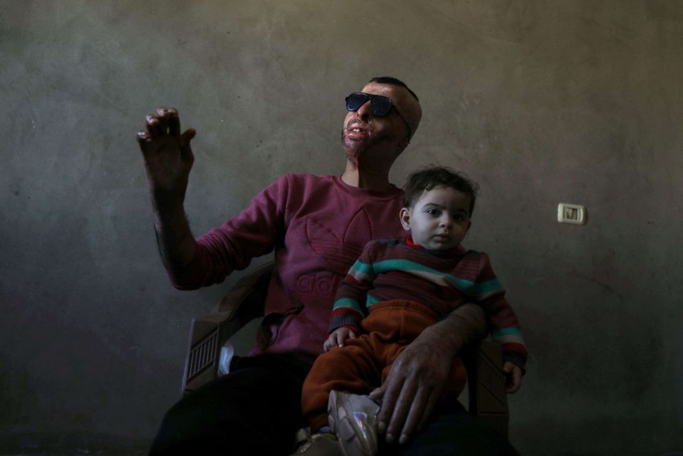 Ahmed al-Natour, palestinese di 34 anni rimasto gravemente ustionato in un incendio l'anno scorso, prova la sua maschera tenendo suo figlio in braccio in casa, a Gaza - Reuters
