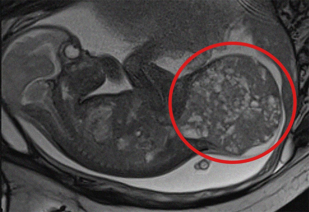 La risonanza che ha evidenziato il tumore da 800 grammi - Ospedale ambino Gesù