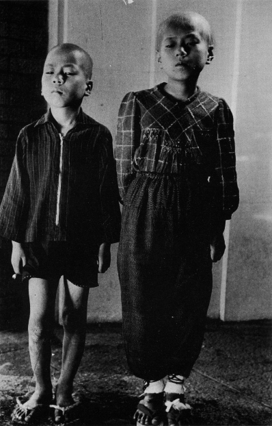 La perdita dei capelli, per colpa delle radiazioni prodotte dell'esplosione della Bomba, di due fratelli sopravvissuti a Hiroshima - Kikuchi Shunkichi / WikiCommons