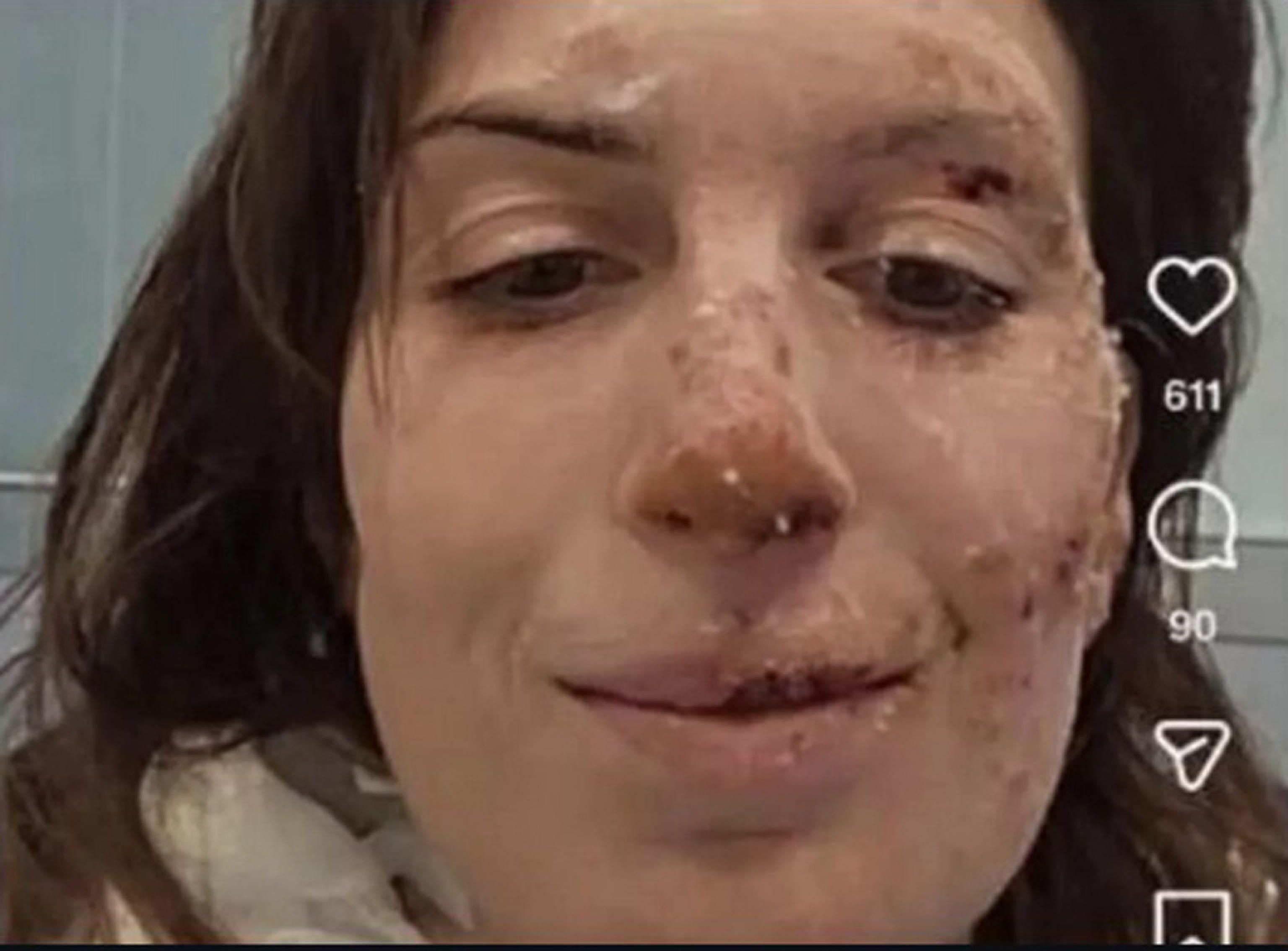 La 29enne Eleonora Palmieri mostra il volto ustionato dal rogo di Crans-Montana in un post sul suo profilo Instagram, pubblicato dall'ospedale Maurizio Bufalini di Cesena&nbsp;